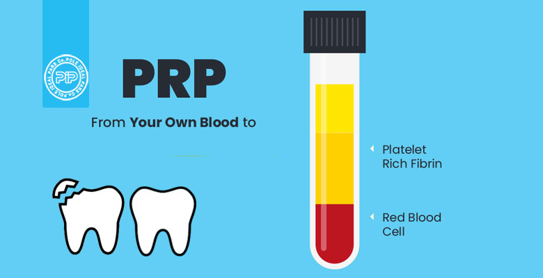 کاربرد PRP در دندانپزشکی: از بهبود زخم تا بازسازی استخوان
