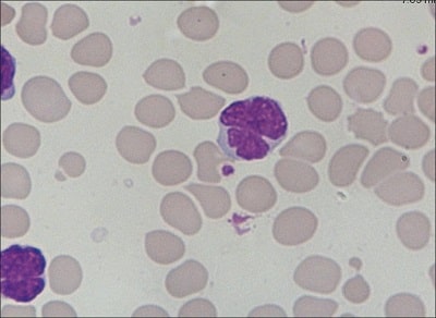 Flower cell در لوسمی سلول T بزرگسالان