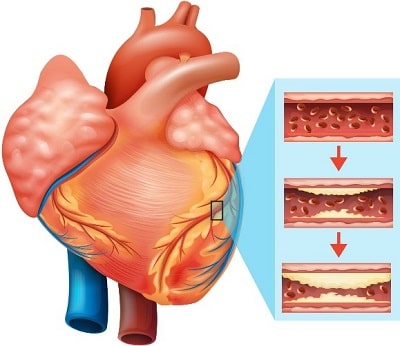 بیماری عروق کرونل، یکی از بیماری‌های قلبی-عروقی است
