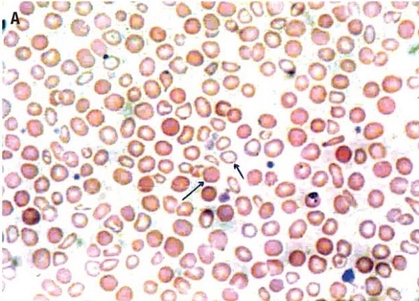 تصویر دیمورفیك خونی مشابه جمعیت دوگانه میكروسیتیك و نورموسیتیك