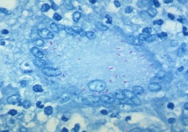 مایکوباکتریوم توبركلوزیس داخل سلول غول (giant cell) رنگ آمیزی زیل نلسون