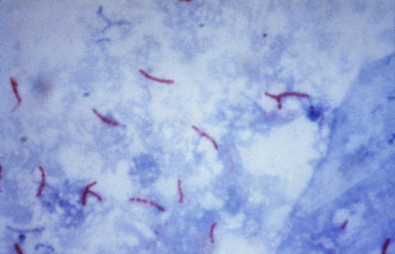 مایکوباکتریوم توبركلوزیس رنگ آمیزی زیل نلسون