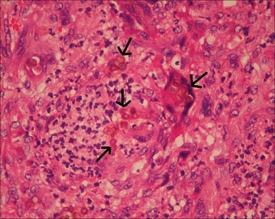 اجسام اسکلروتیک در عفونت کروموبلاستومایکوز در یک گیرنده پیوند کلیه