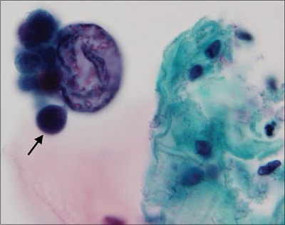 سلول های مخمری کوکرومایسس رکورواتوس در رنگ آمیزی پاپانیکولائو (مشابه پاراکوکسیدیوئیدس)، فرم مخمری در دمای بدن