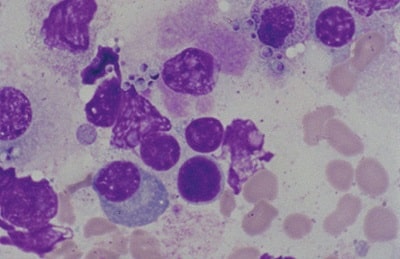 سلول‌های مخمری هیستوپلاسما در هیستوپلاسموز منتشره