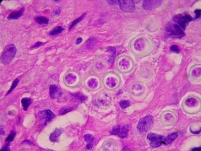 سلول‌های مخمری زنجیری شکل لوکازیا لوبوئی