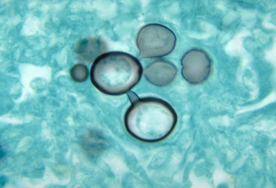 سلول های مخمری پاراکوکسیدیوئیدس برازیلینسیس
