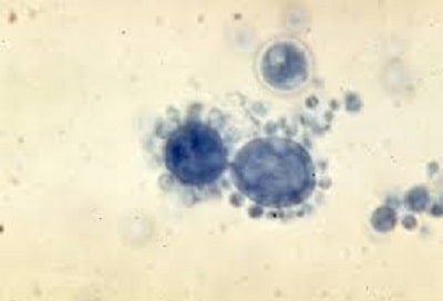 سلول های مخمری پاراکوکسیدیوئیدس برازیلینسیس (منظره فرمان کشتی)