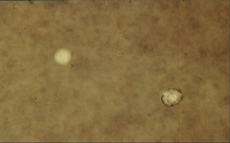 لام تهیه شده با مرکب هندی از نمونه‌ی مایع مغزی نخاعی، در سمت چپ کریپتوکوکوس نئوفرمنس کپسول دار و در سمت راست یک سلول لنفوسیت منکسر کننده‌ی نور مشاهده می‌شود