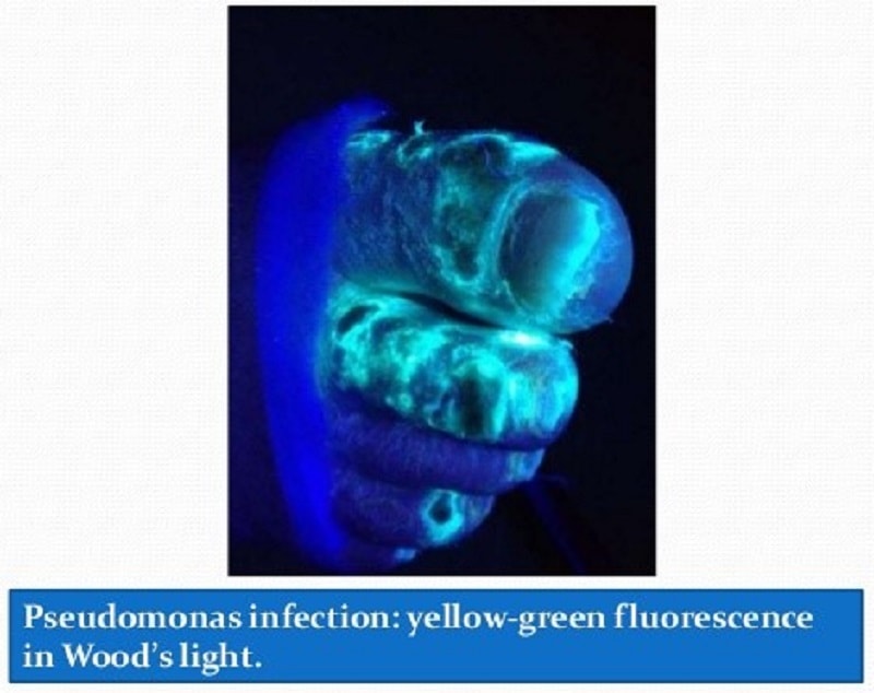 زخم ناشی از سودوموناس فلورسانس در لامپ وود سبز رنگ دیده میشود