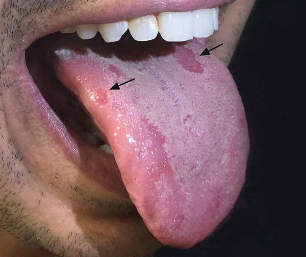 ضایعات دهانی در سیفیلیس مرحله ثانویه