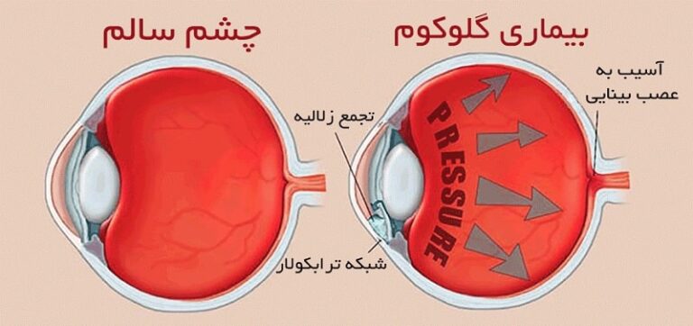 Глаукома латынь. Increased Eye Pressure. Сибирское здоровье глаза глаукома.