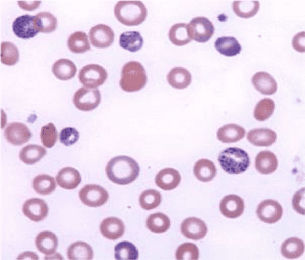 نمونه خون رنگ‌آمیزی شده با رنگ رایت-گیمسا