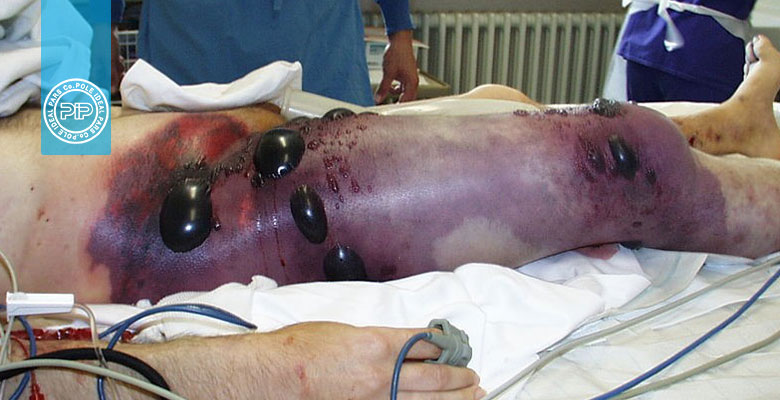 مطالعه موردی میکروبیولوژی (Case Study): مردی 80 ساله با ضایعه کبود رنگ روی پا