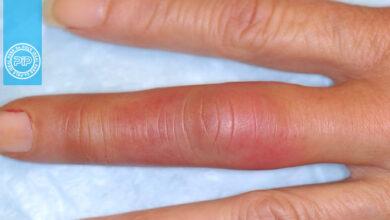 یک فرد 30 ساله با درد پیشرونده در انگشت میانی دست راست