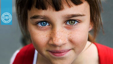 بیماری هتروکرومیا (متفاوت بودن رنگ چشم‌ها)