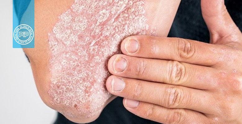 پسوریازیس: یکی از بیماری‌های پوستی شایع