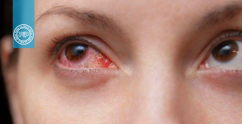 ویروس کرونا و عفونت چشم‌ها