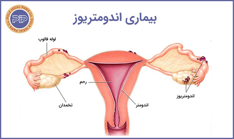 اندومتریوز-Endometriosis