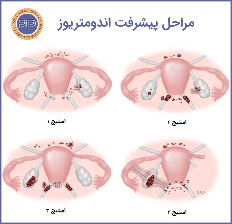 مراحل-پیشزفت-اندومتریوز-آندومتریوز-استیج1-استیج2-پیشرفته-خفیف-endometriosis-stage