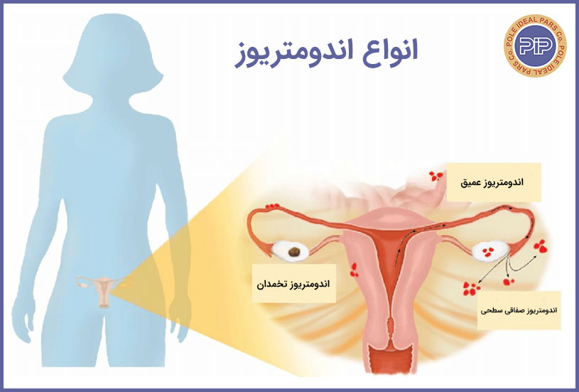 انواع-اندومتریوز-آندومتریوز-endometriosis-types