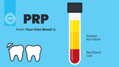 کاربرد PRP در دندانپزشکی