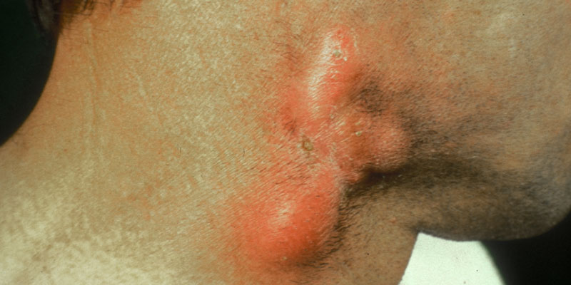 بیماری ناشی از عفونت Actinomyces
