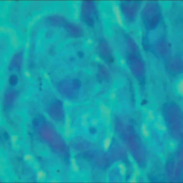 متیل گرین-پیرونین کارسینوم سلول سنگفرشی دهان