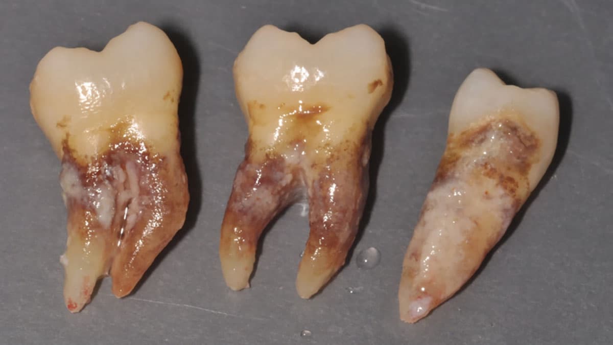 عفونت‌های دندانی ناشی از استرپتوکوک