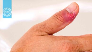 عفونت انگشت : نکاتی که باید در مورد عفونت انگشت بدانید