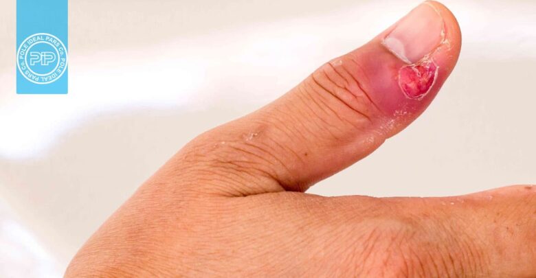 عفونت انگشت : نکاتی که باید در مورد عفونت انگشت بدانید