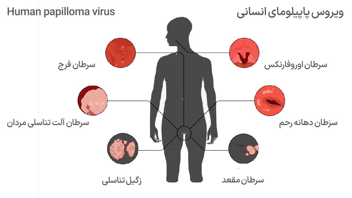 ویروس HPV