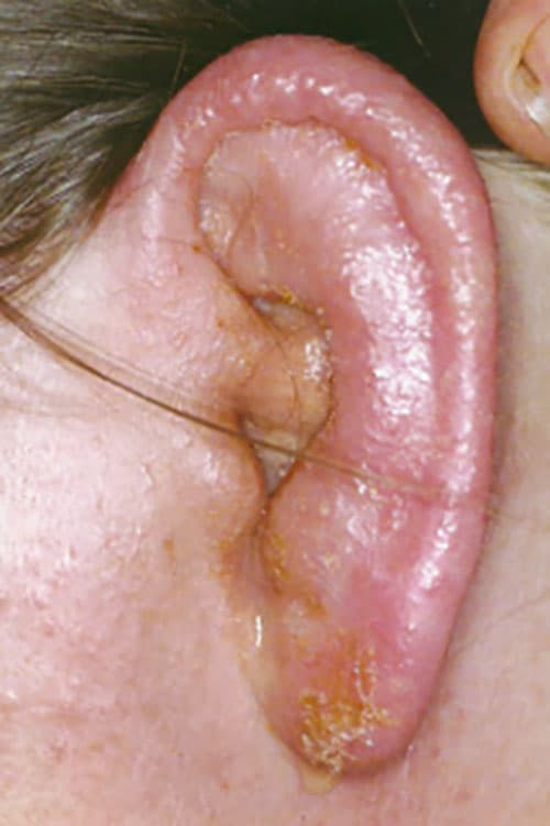 عفونت گوش ناشی از C. auris