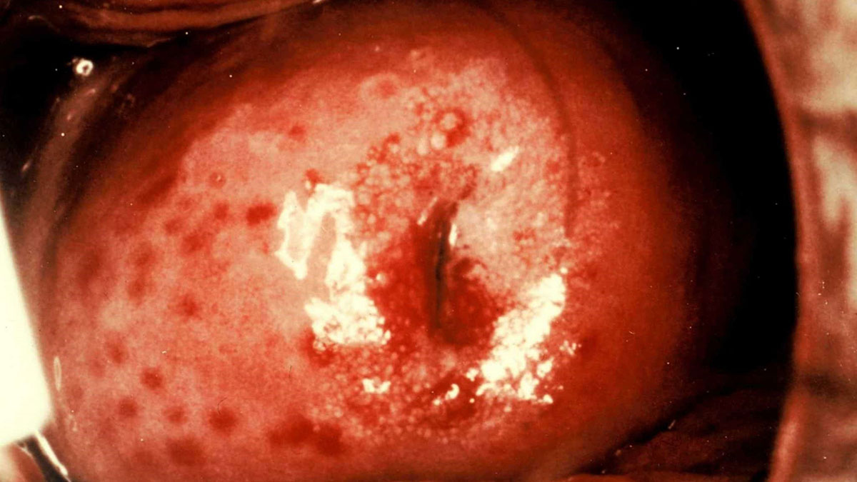 انگل تریکومونیازیس در واژن