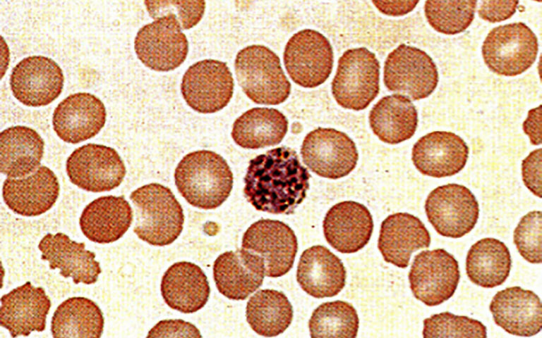 شیزونت بالغ از بیمار مبتلا به عفونت پلاسمودیوم ویواکس