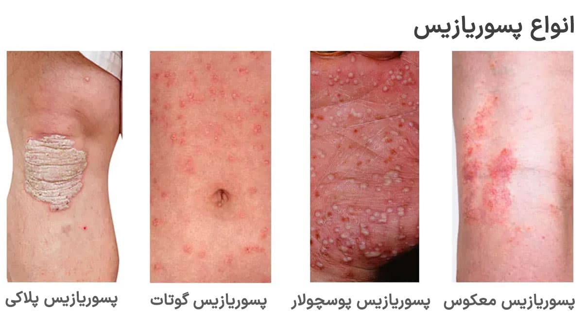 تفاوت بین پسوریازیس و پسوریازیس پلاکی