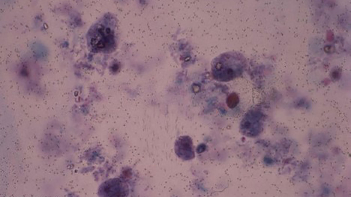 Dientamoeba fragilis