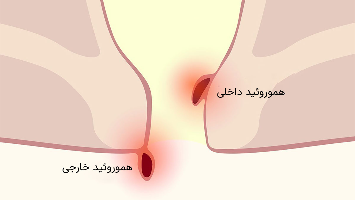 انواع هموروئید