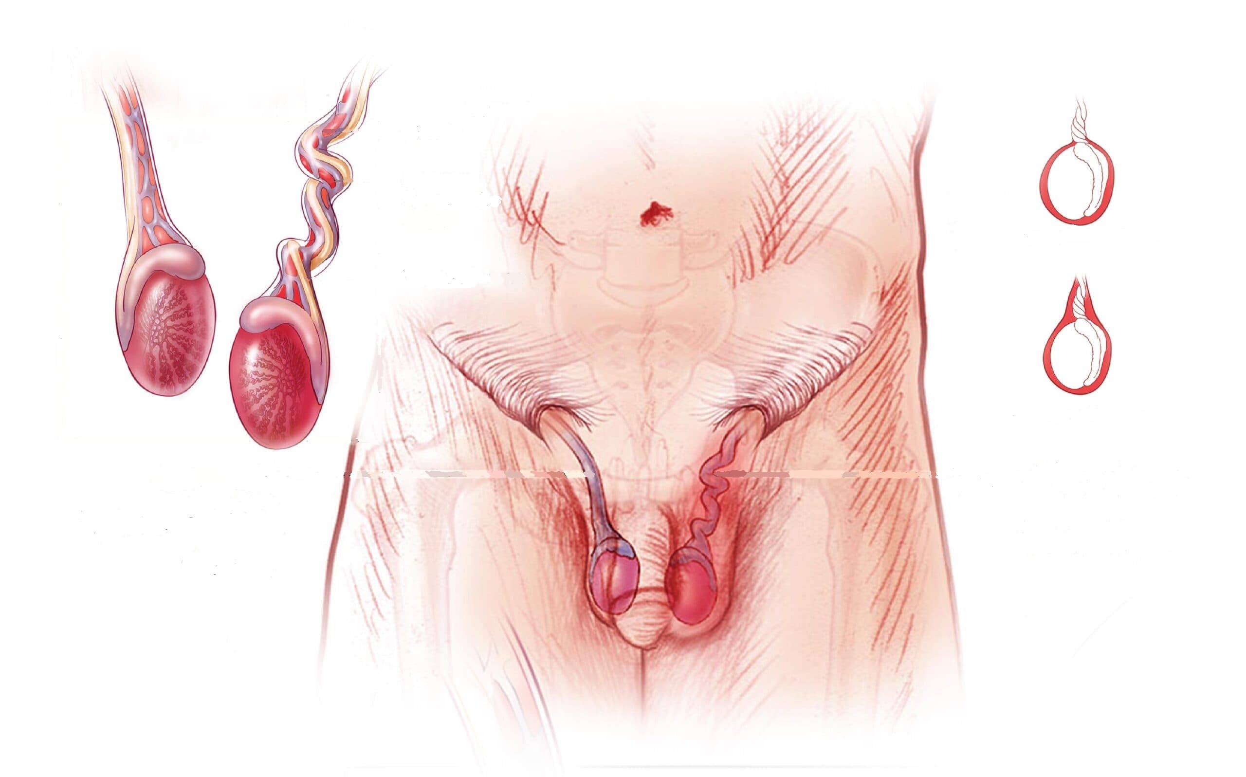 درمان پیچ خوردگی بیضه