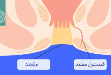 فیستول مقعدی