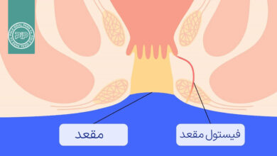 فیستول مقعدی