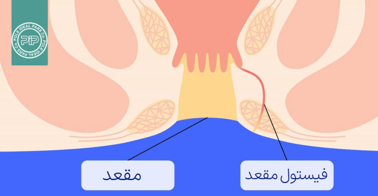 فیستول مقعدی