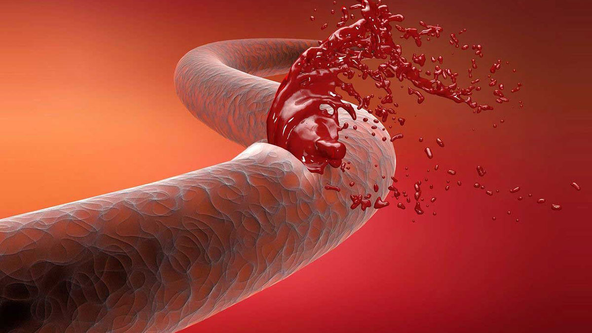 علل و روش‌های مدیریت خون‌ریزی‌های غیرعادی
