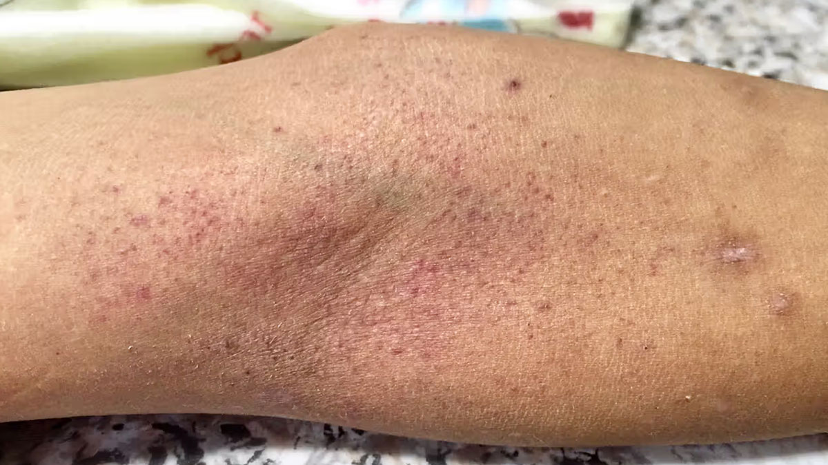پتشی(Petechiae) نشانه پوستی اختلال خونی