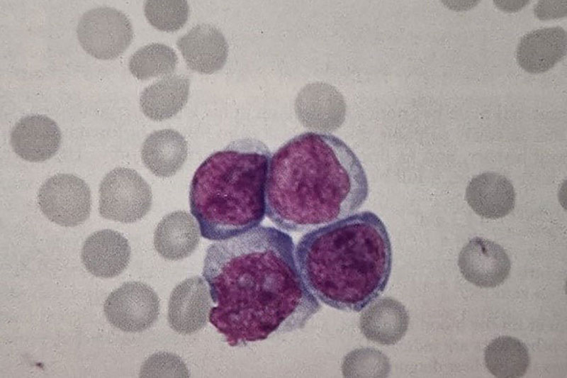 تمایز میلوئیدی CD33) CD13مثبت) و تمایز لنفوئیدی (CD19،TdT مثبت)