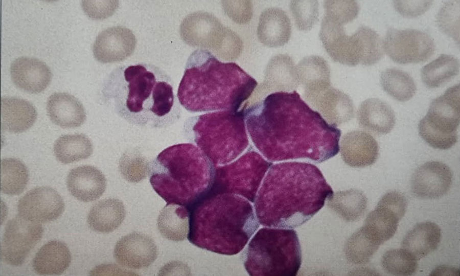 گسترش خون محیطی بیمار