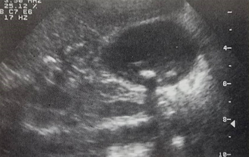 سونوگرافی شکم