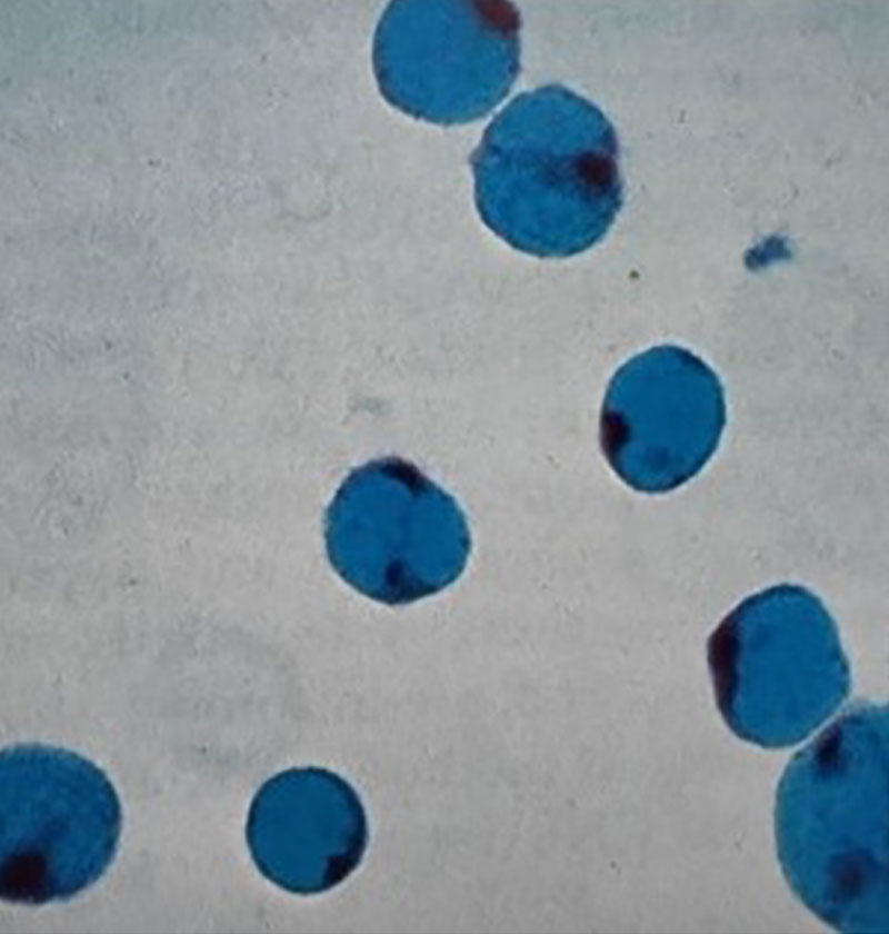 عکس آزمون سیتوشیمی با فسفاتاز اسیدی