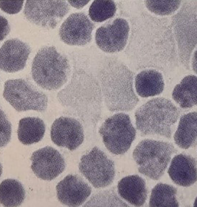 تصویر مارکرهای سلول‌های B مانند CD19 منفی