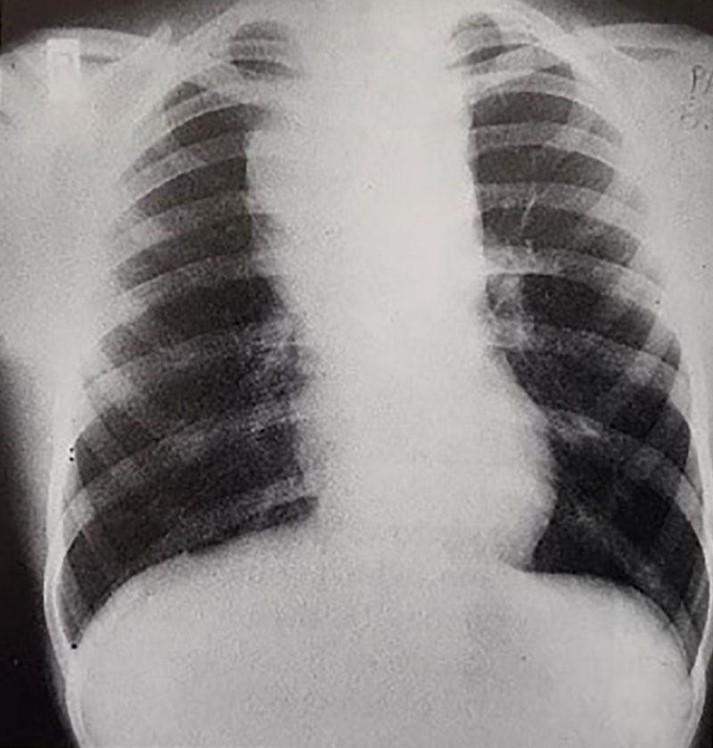 تصویر رادیوگرافی قفسه سینه